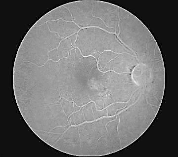 Macular Branch Retinal Vein Occlusion } superior macular more common } 85% macular