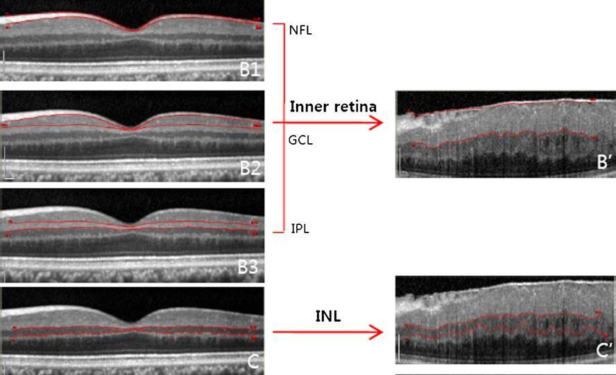 Inner retina predictors Inner retinal thickness - VA Inner Nuclear Layer thickness - metamorrphopsia Takabatake M et al Postoperative changes and prognostic factors of visual acuity, metamorphopsia,