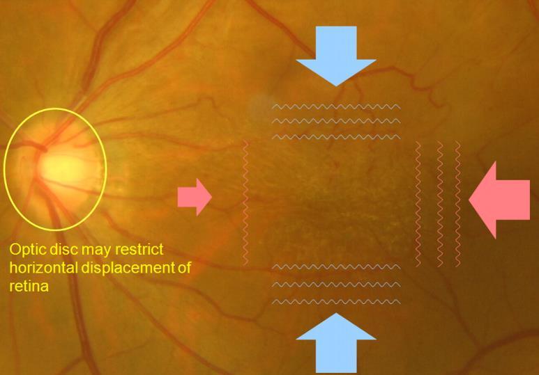 Time Course of Changes in Visual Acuity, Metamorphopsia, Aniseikonia after ERM surgery Takabatake M