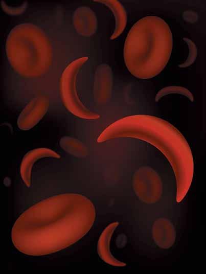 Management of Acute Complications of Sickle Cell Disease A Pocket Guide for the Clinician Timothy McCavit, MD, MSCS 1 Payal Desai, MD 1 University of Texas Southwestern Medical Center The