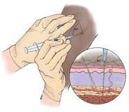 IM administration Use deltoid muscle or upper outer quadrant of gluteal area To make sure needle goes into muscle, stretch skin over injection site, insert needle at 90 angle Pull back on syringe