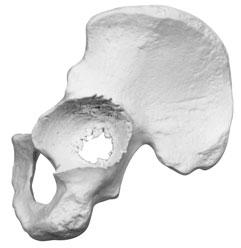 Following acetabular preparation, reassess the acetabulum to evaluate the quality of bone and defect type. Determine if an Acetabular Restrictor and/or Augment is necessary.