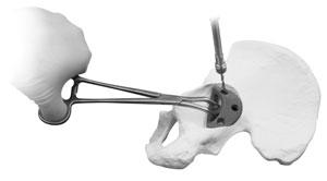 Insert the Acetabular Augment implant using the Augment Implant Forceps. Pre-drill bone holes as needed (B). A depth gauge can be used to aid in determining screw lengths.