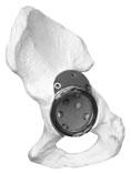 Note: This is necessary to avoid contact between the Acetabular Restrictor and the cup.