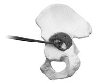 5SURFACE PREPARATION Place doughy bone cement across the concave surface of the Acetabular