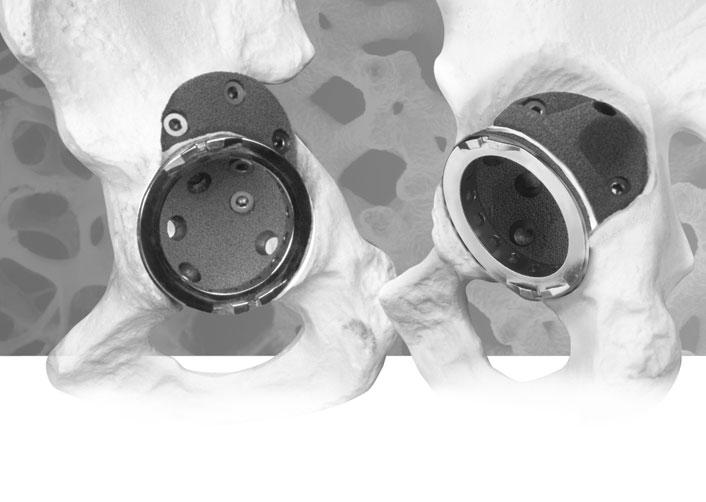 Acetabular Cup position and patient kinematics remain uncompromised, as when using structural grafts.