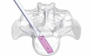 Insert the Trial Implant into the disc space by light impaction and confirm the proper position with the aid of anterior-posterior and lateral fluoroscopy.