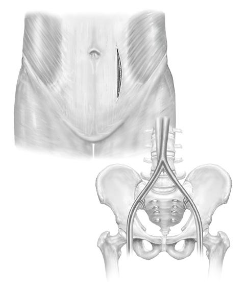 The affected partial vertebral body and disc material is excised and the both superior and inferior surfaces are prepared. (Fig.