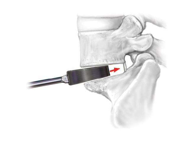 4 OPERATIVE TECHNIQUE - PILLAR SA PEEK AND PTC SPACER SYSTEM 4. DISCECTOMY AND DISC SPACE PREPARATION Perform a complete anterior lumbar discectomy and remove all residual interbody material.