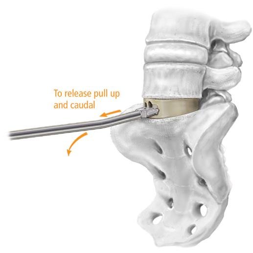 6 OPERATIVE TECHNIQUE - PILLAR SA PEEK AND PTC SPACER SYSTEM To release pull up then caudal Implant Insertion Instrument 6.