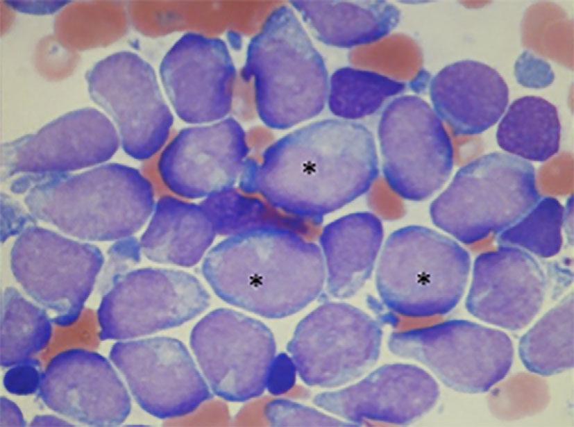 The authors state that they have no Conflict of Interest (COI). References Figure 5. Bone marrow puncture shows the accumulation of myeloblasts ( ).