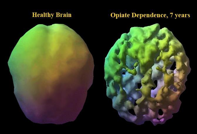 A CHRONIC BRAIN DISEASE Healthy Brain Opiate Dependence, 7yrs courtesy of Daniel Amen, M.D. courtesy of Daniel Amen, M.D. All contents copyright 2018 Enterhealth LLCCourtesy of Daniel Amen, M.