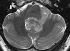 central causes à MRI periventricular (4th ventricle) lesions (MS-plaque, neoplasms) (small)