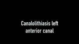 Canalolithiasis left anterior (during