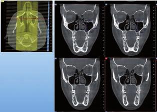 3D Native CBCT technology allows selection of multiple applicative modes with different FOVs and personalised parameter