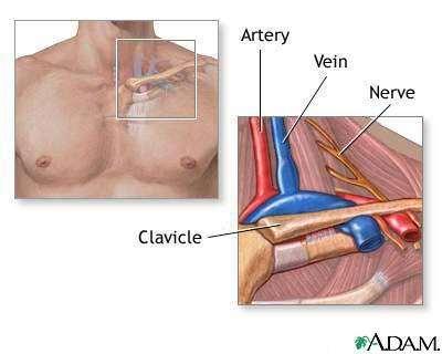 THORACIC OUTLET SYNDROME Rare condition that occurs when there is compression of vessels and nerves in the area of the