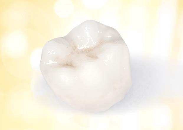 Dentists now have the option of using preshaped, aesthetically layered crowns made of a high-performance polymer material (IPN).