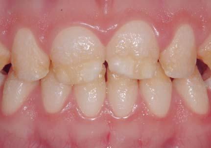 The initial situation is characterized by massive enamel development deficiencies, discolouration