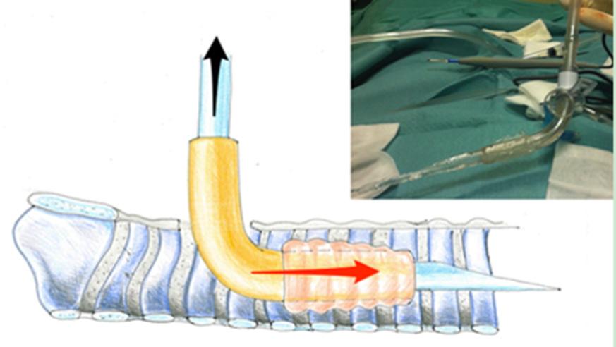 The tracheal incision is horizontal and obtained with an 11-number surgical blade between the first and the second tracheal ring, then the incision is gently dilated with a Laborde s forceps.