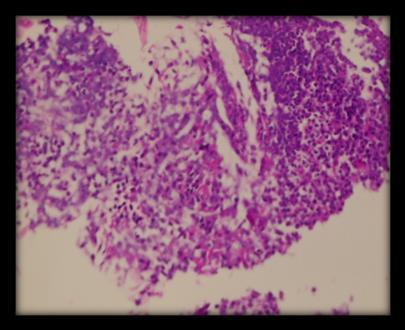 The histopathology of the polyp was that of an inflammatory myofibroblastic tumour of the trachea (Fig 3a) further confirmatory tests were done in the form of smooth muscle actin (Fig 3b) and