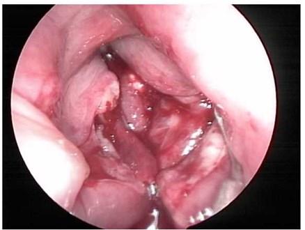 Fig.l: A preoperative endoscopic examination showed a supraglottic laceration with extensive endolaryngeal mucosal edema. Fig.3: Intraoperative approach to the endolarynx tissue via the midline.