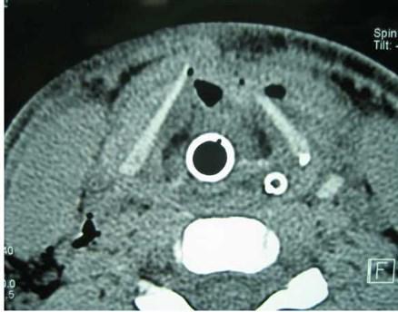 2: A CT scan revealed an open book fracture (double black arrow) of the anterior portion of the left thyroid lamina with some degree of soft tissue emphysema.