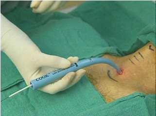 Percutaneous dilatational tracheostomy is done at the patient s bedside, usually in