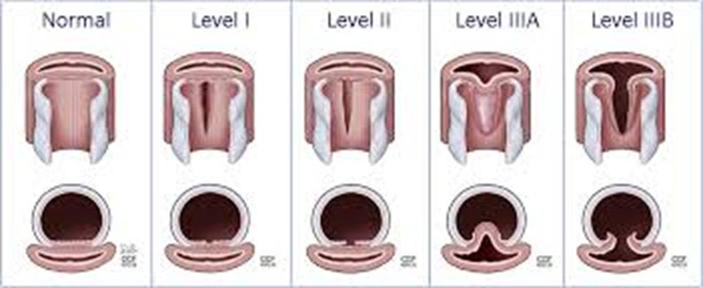 Tracheal Wall Injury: Morphologic Classification Level I Mucosal or submucosal injury without mediastinal emphysema and esophageal injury Level II Lesion extending to the muscular wall with
