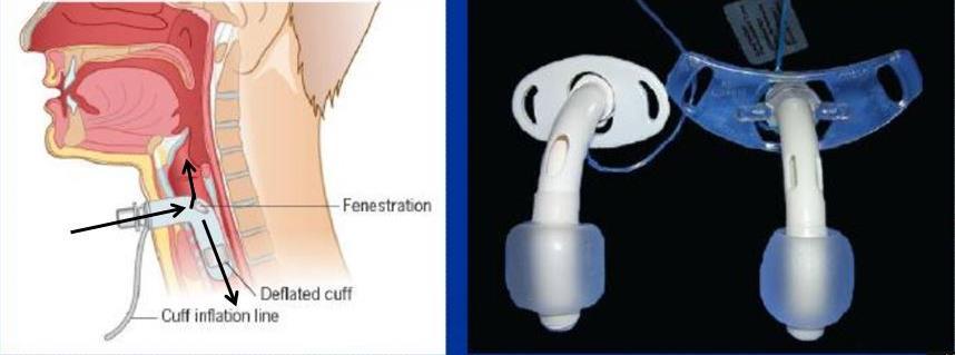 Troubleshooting Tracheostomy problems To Improve Natural Speech: Use non-cuffed cannula instead of