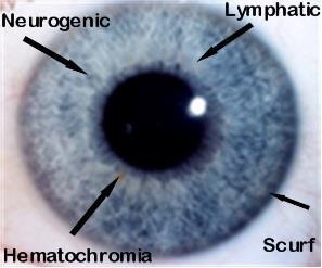 EYES Hematogenic (Brown eye)-- Glandular, Lymphatic congestion (LvGB) 1.Chronic Stress Rings -fibers buckle 2.