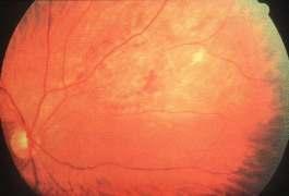 He complains of blurring of vision and is seen by the ophthalmologist who diagnoses CMV retinitis He should commence.. 1.
