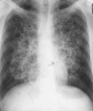 A 36 year old male attends A and E complaining of increasing shortness of breath and a dry cough He