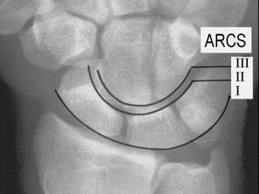 Radiographs Gilula s Arcs Seen on AP wrist Broken arc indicates disruption of