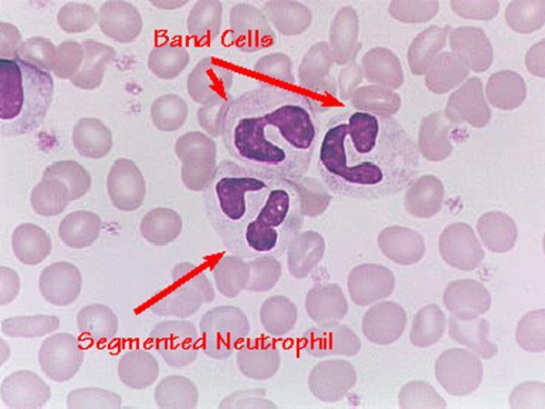 Neutrophils Neutrophils consist of band neutrophils and segmented neutrophils, the latter being the most mature type.