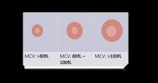 Mean corpuscular volume (MCV) The MCV is the mean volume of all the erythrocytes counted MCV = Hct RBC count Microcytic, Macrocytic, and