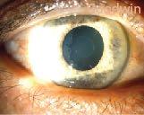 Exfoliation syndrome can result in severe chronic open angle glaucoma.