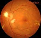 This includes conditions such as diabetes (See Figure 5), carotid artery disease, and a history of central retinal artery occlusion or central retinal vein occlusion.