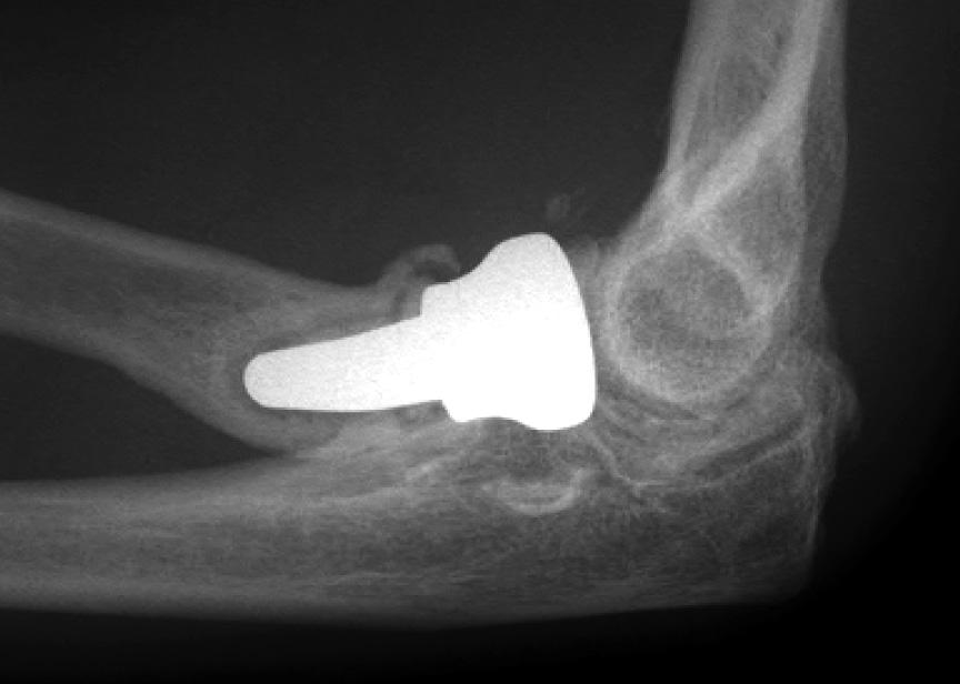 FAILURE OF METAL RADIAL HEAD REPLACEMENT 663 Fig. 1 Lateral radiograph showing loosening of a cemented implant. Fig. 3 Lateral radiograph showing radiolucent lines around the stem of an implant revised for pain.
