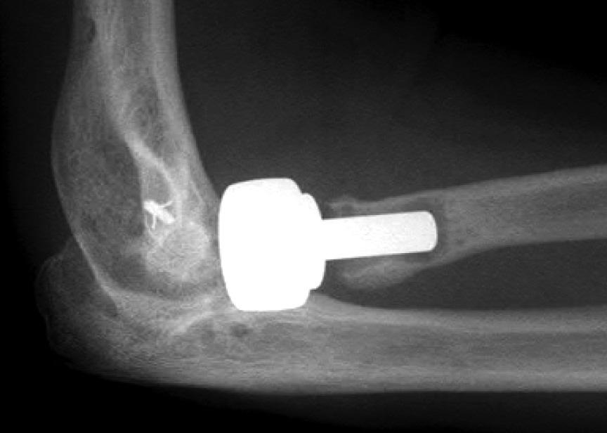 Radiographs were analysed for loosening, instability and radial over-lengthening relative to the lesser sigmoid notch of the ulna, 15 so-called joint over-stuffing leading to asymmetry of the