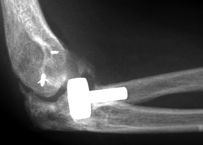 18 Any degenerative changes were graded using the Broberg and Morrey osteoarthritis (OA) scale, 19 where 0 represents a normal elbow, and 1, 2 and 3 represent mild, moderate and severe degenerative