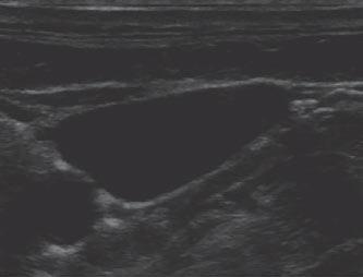 This feature can be useful when trying to visualize more distal targets at depths where the penetration of the ultrasound is poor.