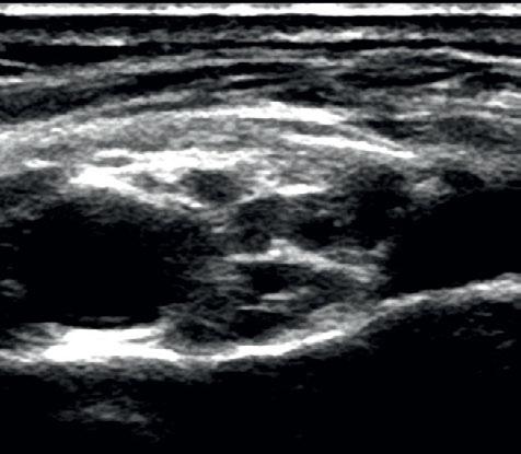 0 cm 1 R Brachial plexus Subclavian artery First rib 2 R Fig 5 Vascular and bony landmarks in an ultrasound scan: locating the brachial plexus 3 Scan landmarks Use vascular and bony landmarks to