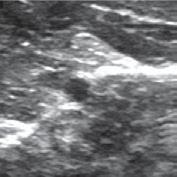 N N N Ulnar nerve Ulnar artery N Ulnar nerve N N Ulnar nerve Ulnar artery Fig 6 Tracking the ulnar nerve from wrist to forearm Slight tilting movement of probe minimizes anisotropy effect Ultrasound