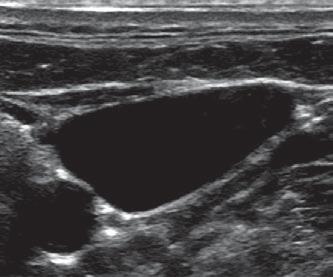 Fig 13 Scans of an artery and a vein, showing collapse of vein with pressure applied to probe Vein Vein rtery rtery rtery and uncollapsed vein rtery and collapsed vein due to probe pressue