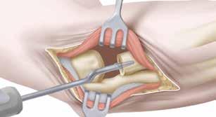 The radial head trial has an undersized stem to allow insertion without dislocation of the elbow and for maintaining the integrity of the medullary canal for the final press fit.