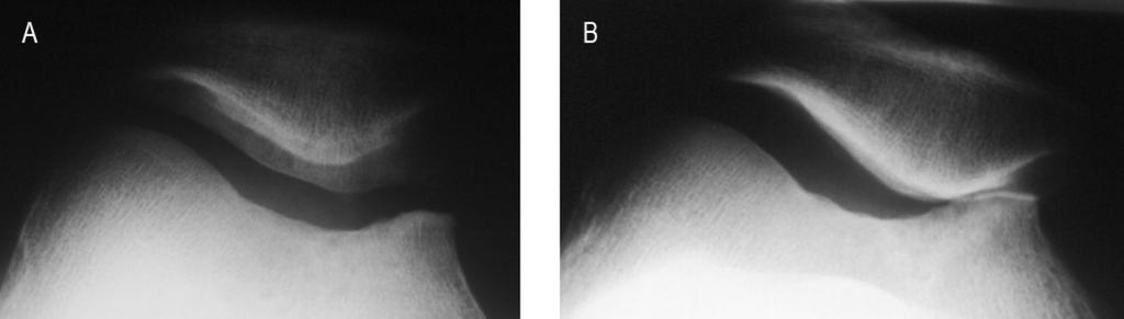 Fig. 4: Supine (A) and standing (B) axial radiographs of the PF joint in a 41-year-old female. The joint spaces are normal in the supine position (A).