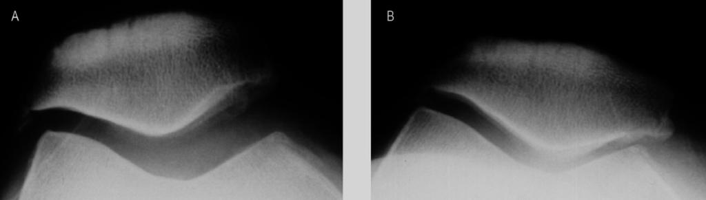 5: Supine (A) and standing (B) axial radiographs of the PF joint in a 62-year-old female. (A) shows widening of the medial joint space in the supine position.