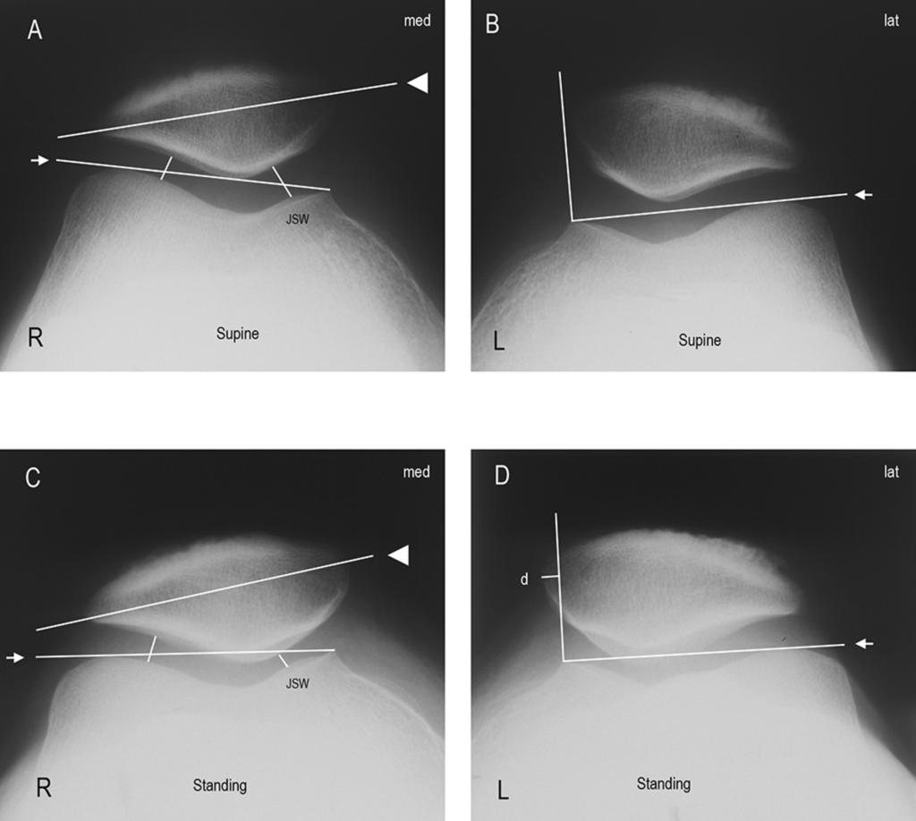 displacement and reduction of the patellar tilt angle. Eleven/twelve percent of the knees showed opposing direction of change in position with negative differences. Fig.