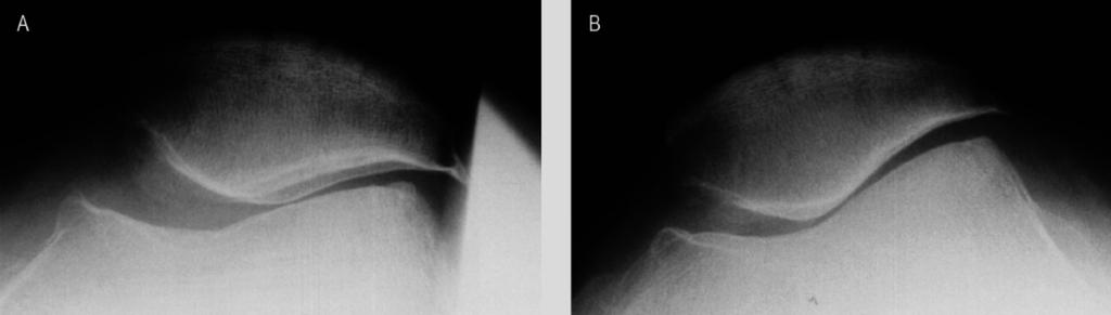 Fig. 6: Supine (A) and standing (B) axial radiographs of the PF joint in a 69-year-old female.