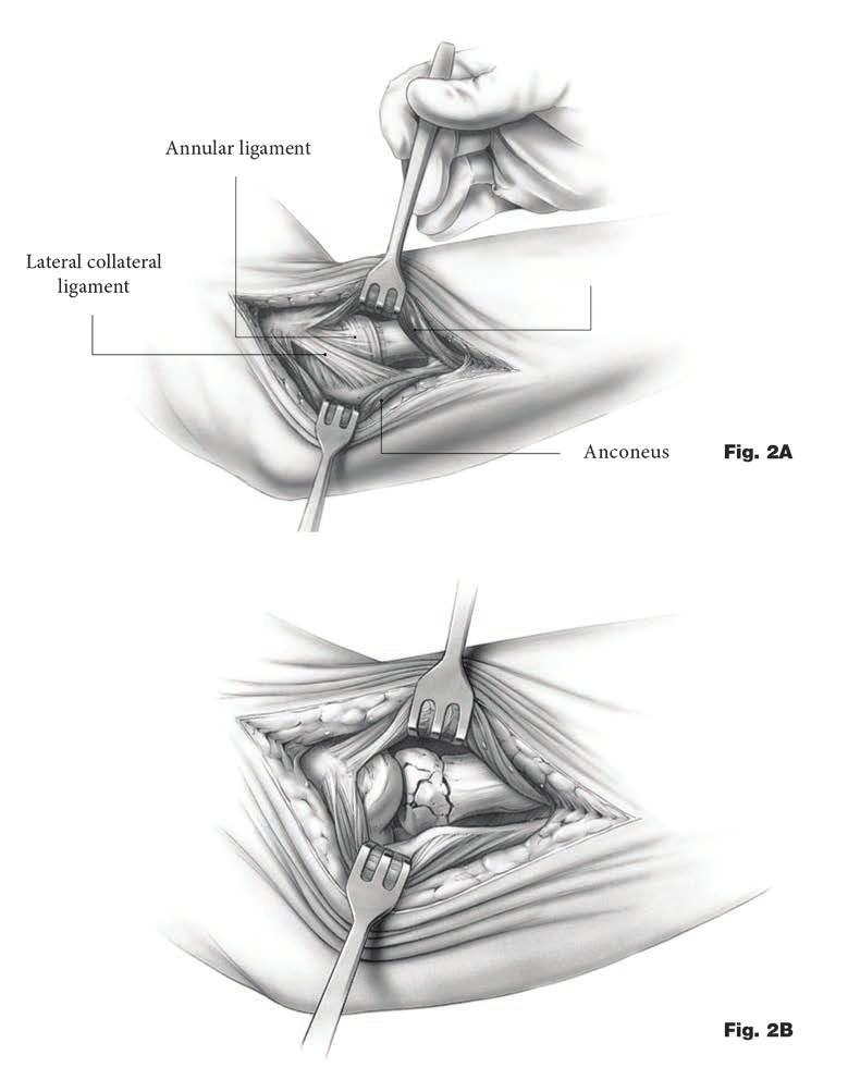 rhead System Capsular exposure If the elbow is stable, the capsule is exposed by elevating a portion of the extensor carpi ulnaris sufficiently to allow identification of the lateral collateral